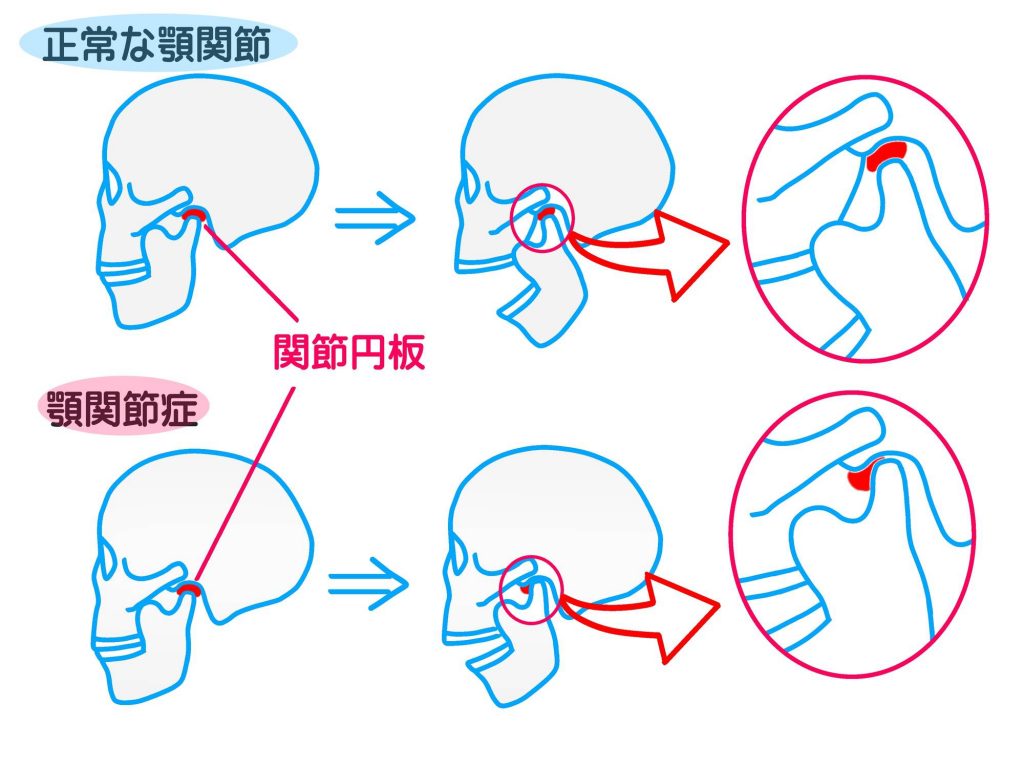 顎関節症について